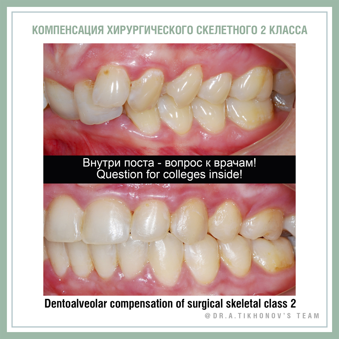 Компенсация хирургического скелетного 2 класса. - интересно об ортодонтии,  имплантации и протезировании зубов